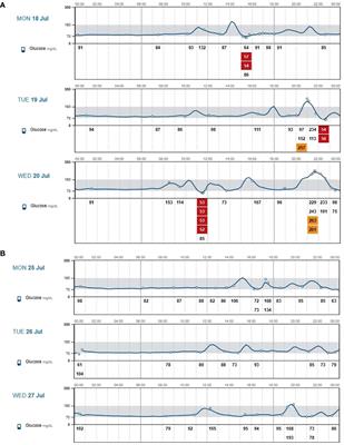 Case Report: Post-gastrectomy reactive hyperinsulinemic hypoglicaemia: glucose trends before and after canagliflozin treatment